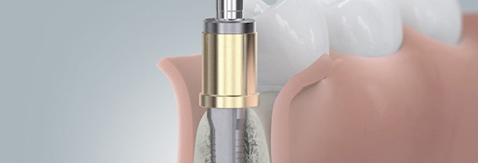 implantation_setzten2 implantation_setzten2