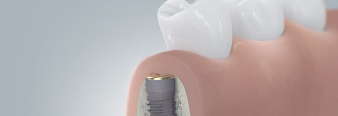 implantation_setzten3 implantation_setzten3