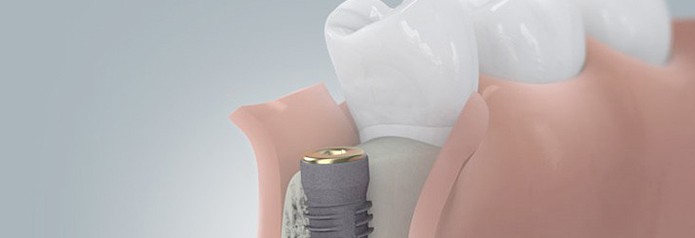 implantation_setzten4 implantation_setzten4