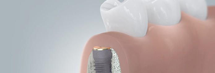 implantation_setzten5 implantation_setzten5