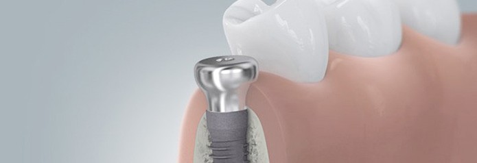 implantation_setzten6 implantation_setzten6