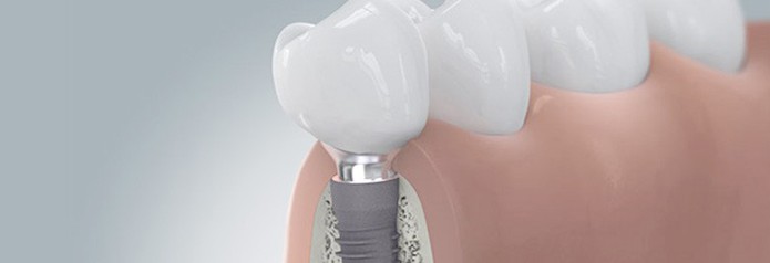 implantation_setzten7 implantation_setzten7